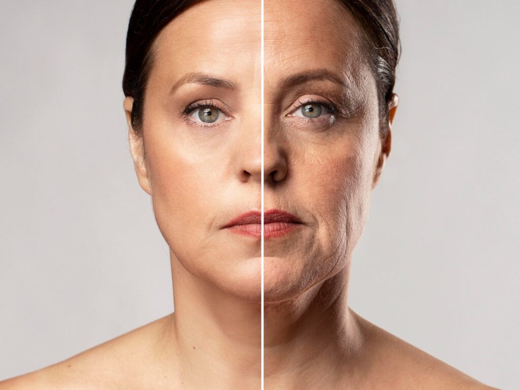 Antes y después del rostro con bioestimulador de colágeno