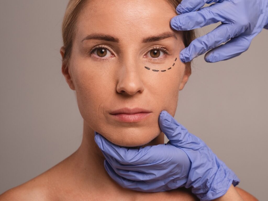 Marcación del área bajo los ojos para un relleno de ojeras